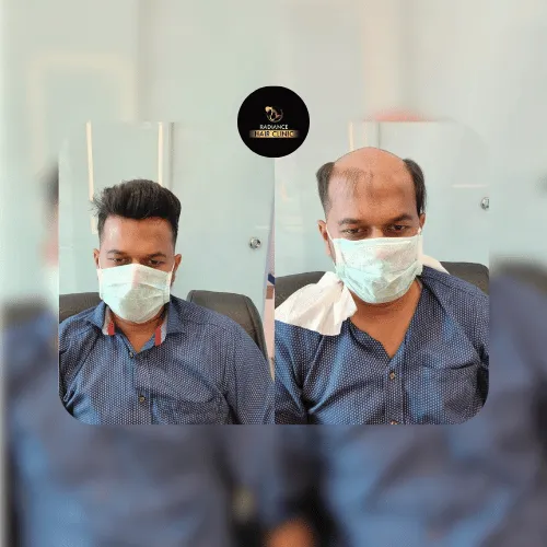 PRP Therapy Results - Before