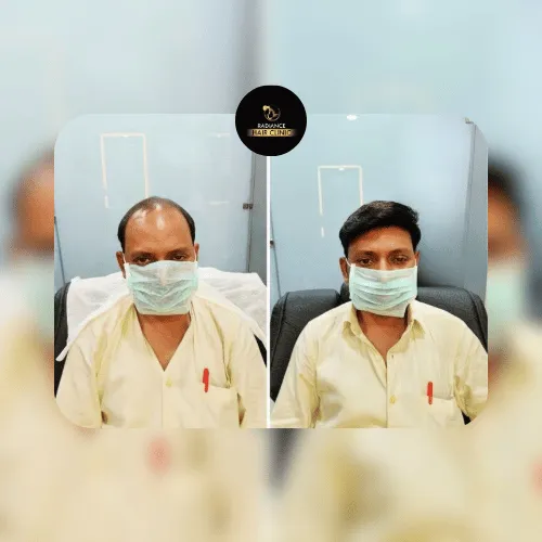 PRP Treatment Success - Before