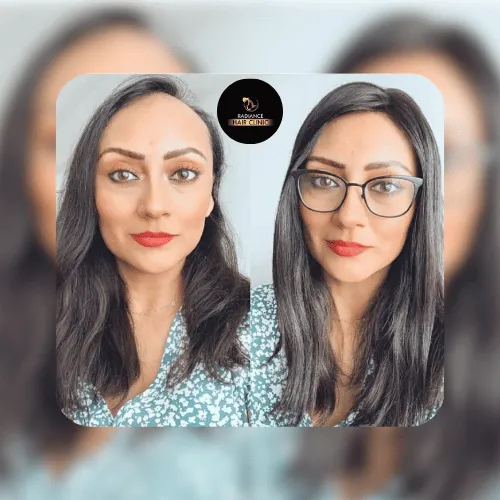 Hair Transplant - Before & After - Before